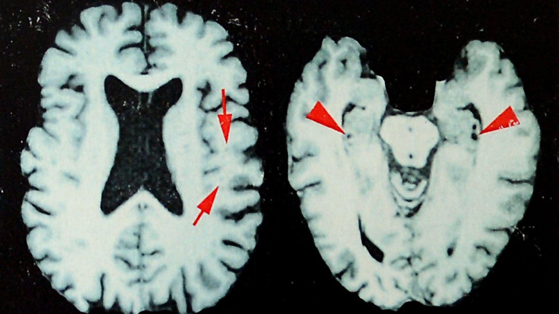Brain scans of a former NFL player who was diagnosed with CTE