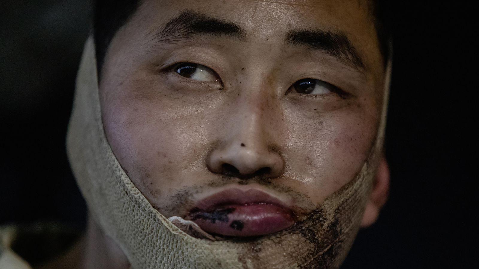 The image shows a close-up of man's face. He has a bloodied lip and bandage around his jaw and he is looking away from the camera