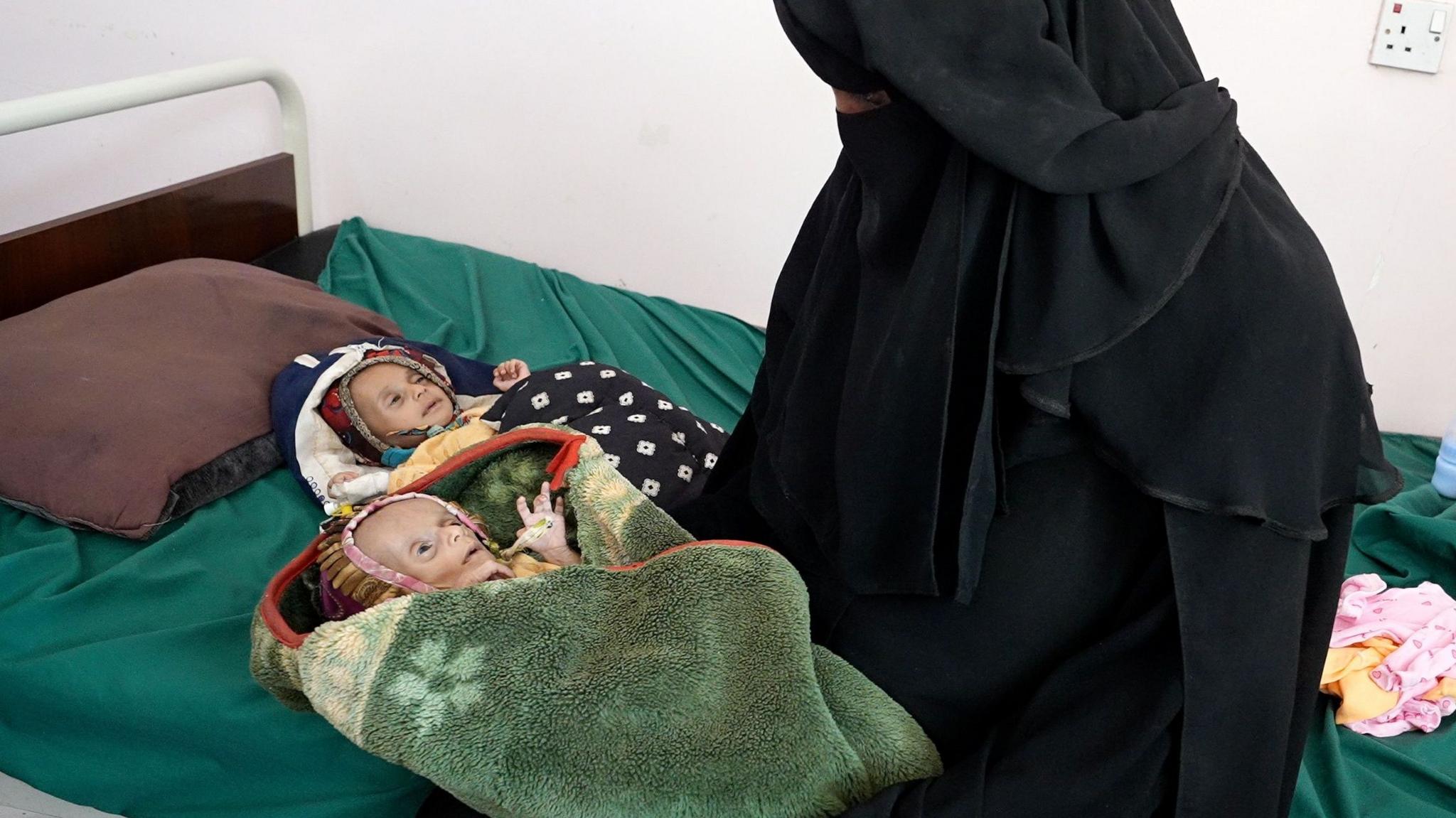 Raad Hassan is held by his mother Lina, as his twin sister Raghad lies beside him on a bed at a hospital in Aden, Yemen